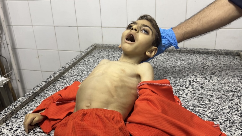 בתוך 72 שעות: 21 ילדים מתו בעזה בשל תת-תזונה ורעב