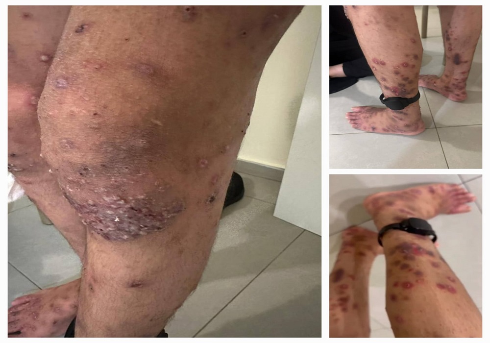 כרבע מהאסירים הפלסטינים בבתי הכלא נדבקו בסקביאס בחודשים האחרונים