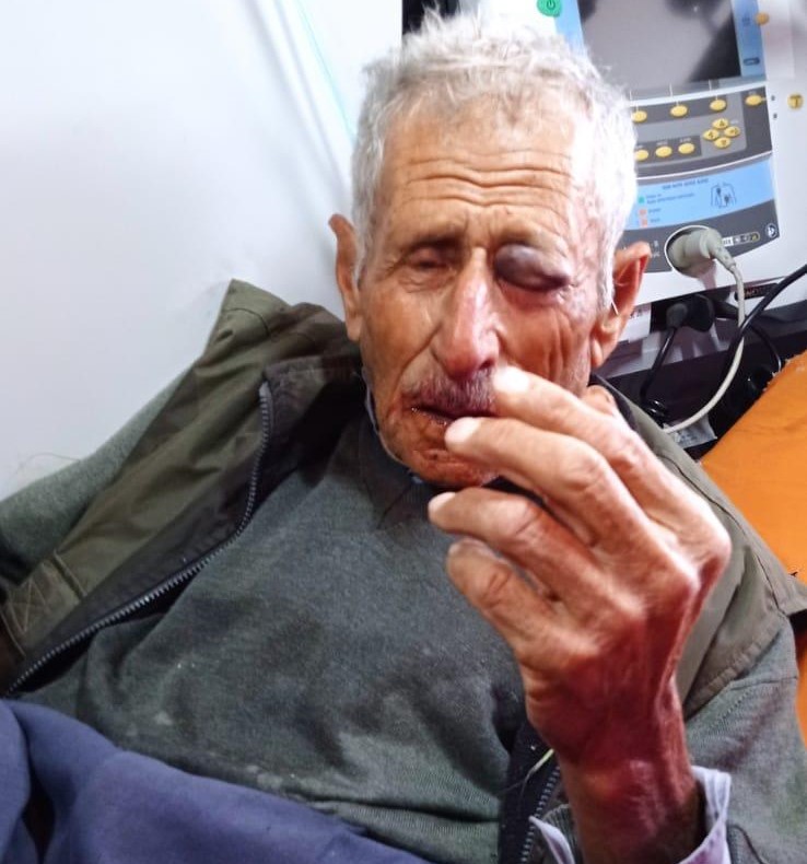 מתנחלים תקפו קשיש וגרמו לו חבלות קשות ושברים