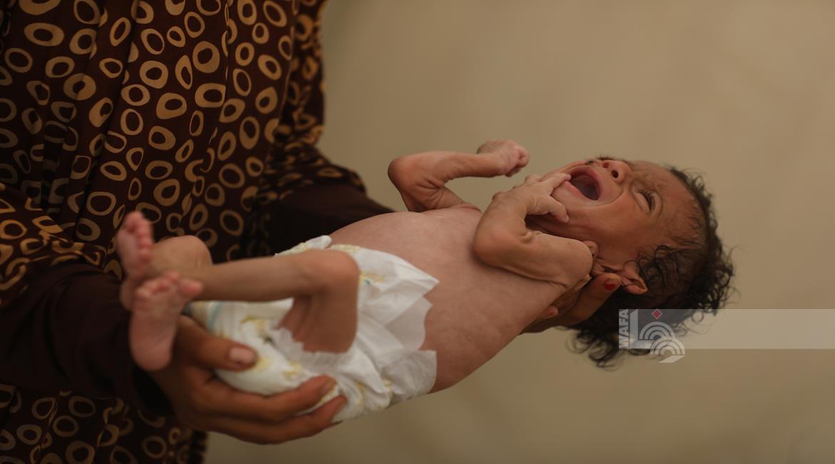 מותם של שני ילדים כתוצאה מרעב ותת־תזונה בעזה