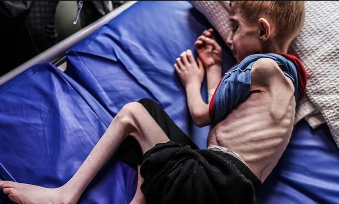 רופאים ללא גבולות: מדיניות הרעבה ישראלית מחריפה את תת־התזונה בקרב ילדים בעזה