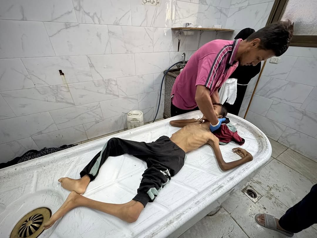 10 מקרי מוות מרעב ותת־תזונה ברצועת עזה ב־24 השעות האחרונות