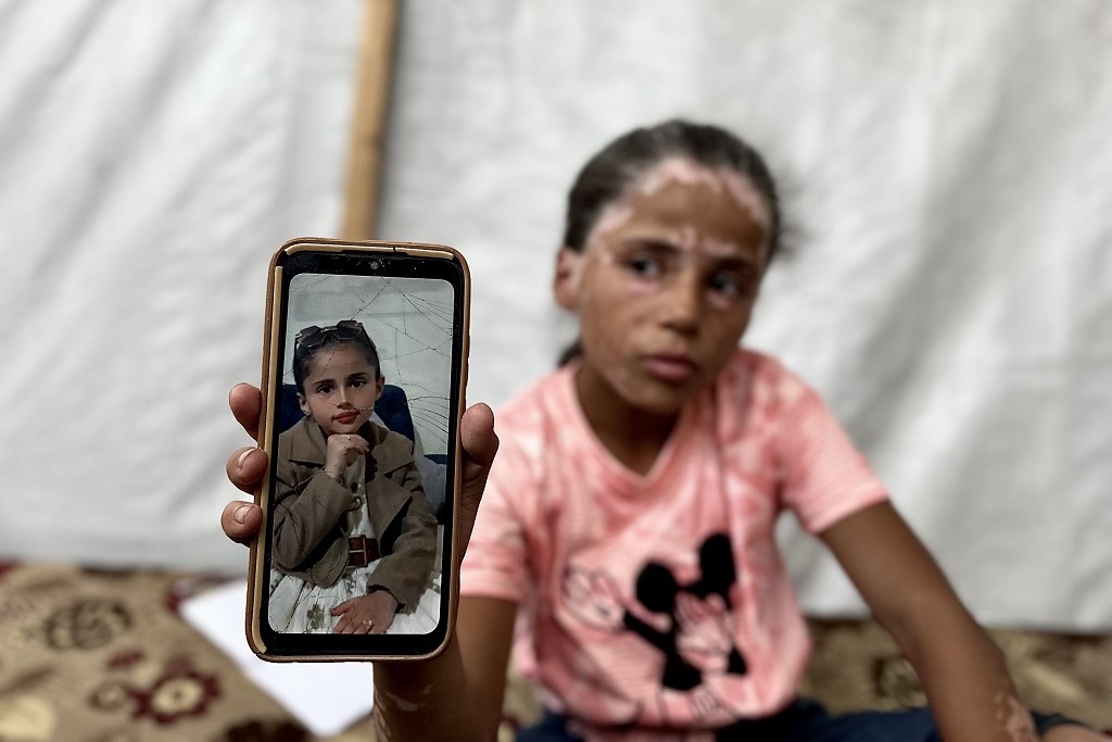 "הייתי פעם יפה": לנה א-שריף, ילדה בת 10 מעזה, איבדה את ילדותה — ואת צבע שיערה — תחת המתקפה הישראלית