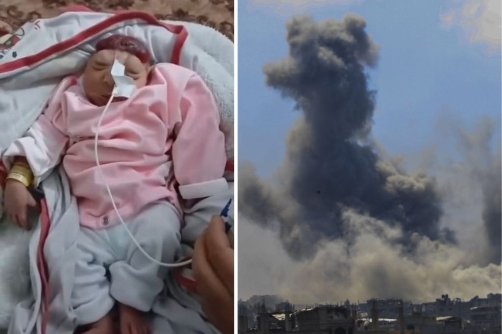 תינוקת נולדה ללא מוח בבית חולים בצפון עזה – רופאים מזהירים: גידול חד במקרי מומים מולדים מאז תחילת המלחמה