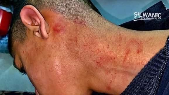 הילד עלי הוכה שפניו מכוסות