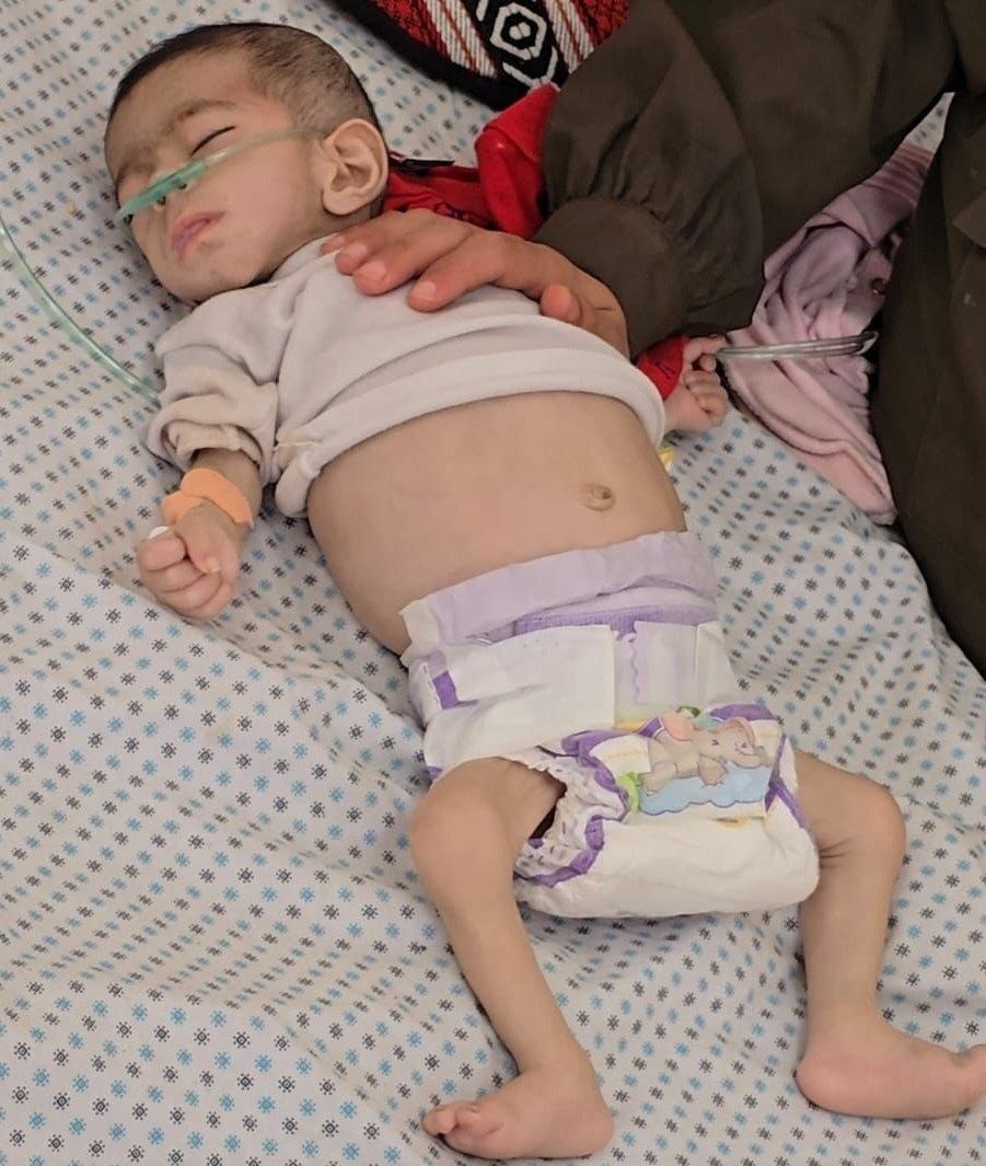 מתה מרעב: בת שנה וחצי מתה בבית חולים בעזה — 54 קורבנות לתת-תזונה מאז תחילת המצור