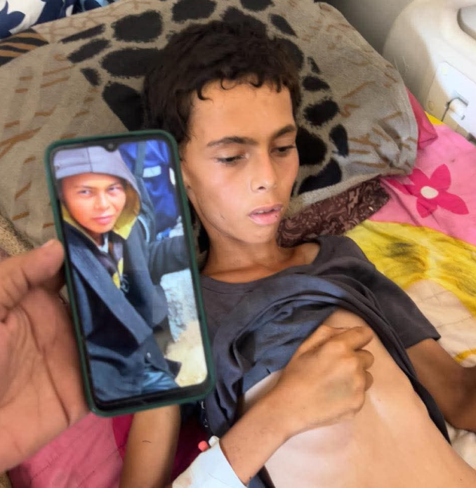 נער מת בעזה מרעב – יותר מ־160 קורבנות תת־תזונה מאז תחילת המתקפה